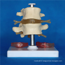 Human Lumbar Intervertebra Disc Medical Care Model (R020708)